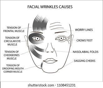 Woman's face demonstrating facial wrinkles causes