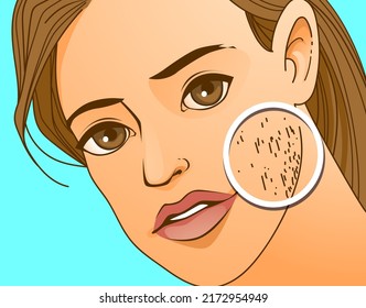 A woman's face with health problems. Hirsutism. Before, after. Medical illustration. Vector illustration. 