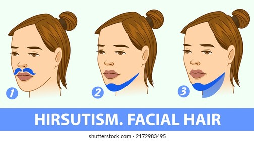 A woman's face with health problems. Hirsutism. The areas of the facial hair.  Medical illustration. Medical infographic. Vector illustration. 