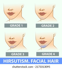 A woman's face with health problems. Hirsutism. The areas of the facial hair.  Medical illustration. Medical infographic. Vector illustration. 