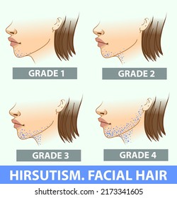 A woman's face with health problems. Hirsutism. The areas of the facial hair.  Medical illustration. Medical infographic. Vector illustration. 