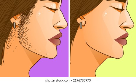 A woman's face with health problems. Hirsutism. Before, after. Medical illustration. Vector illustration.