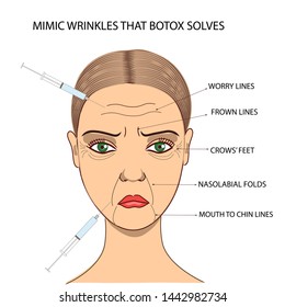 Woman's face with mimic wrinkles that can be reduced with injections