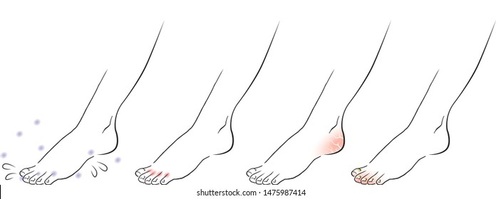 Woman's Feet With Athlete's Foot