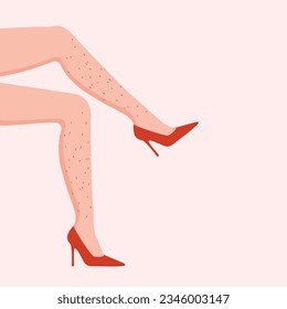 Womans leg without epilation. Unshaved body parts. Body positive concept. Female hairy legs in a high red heels. Vector illustration.