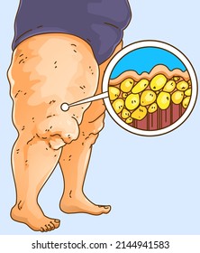 The woman's legs with health problems. Lipedema fat closeup illustration. Healthcare illustration, medical infographics. Vector illustration. svg