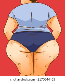 The woman's legs with health problems. Lipedema fat closeup illustration. Healthcare illustration. Vector illustration. svg