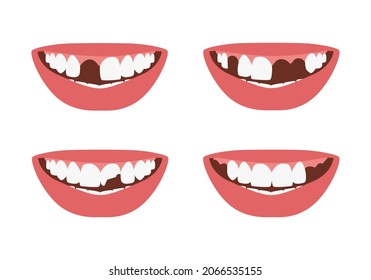 Woman's mouth with missing, broken teeth. Lost incisor, molars. Dental problems isolated set. Vector illustration