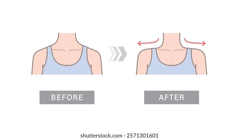 Woman's neck from behind before and after botulinum toxin. Muscular shoulder line and straight slim shoulder line.