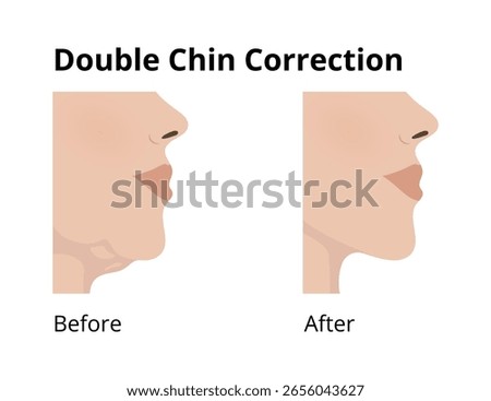 Woman's profile highlighting transformation before and after double chin correction, showcasing enhanced facial contour and noticeable reduction of submental fat for improved aesthetics