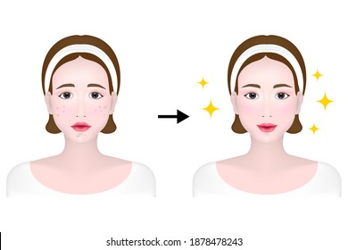 Mujeres antes y después de usar crema de acné, cabeza negra, cabeza blanca, pápula, pustula, problemas de piel