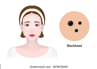 Women and blackhead acne, Skin problem vector