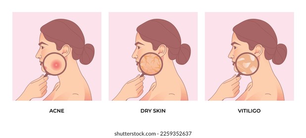 women face with Different types of Different types of skin problems, acne, pimples, skin pores, dry skin and vitiligo. Skin care concept.