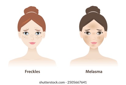 The women with freckles and melasma on skin face vector illustration isolated on white background. Types of pigmentation, Freckles, Ephelides, Solar Lentigines, Actinic lentigines and melasma.