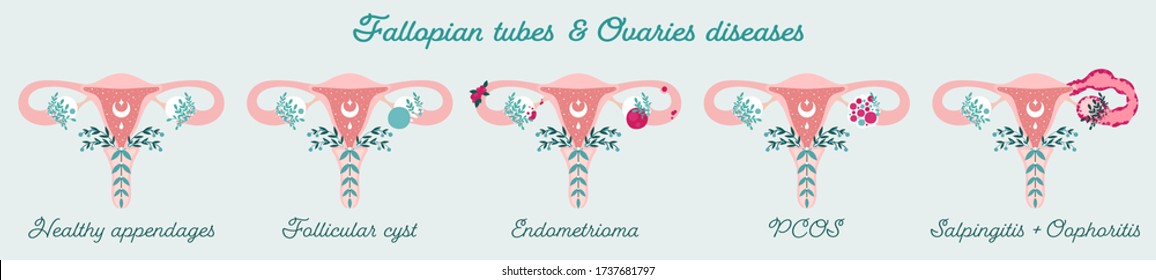 Women Health - Fallopian Tubes And Ovaries Disorders - PCOS, Endometrioma E.t.c. Gynecological Diseases - Patient-friendly Infographic. Uterus In Flowers Diagram - Isolated Anatomical Schemes