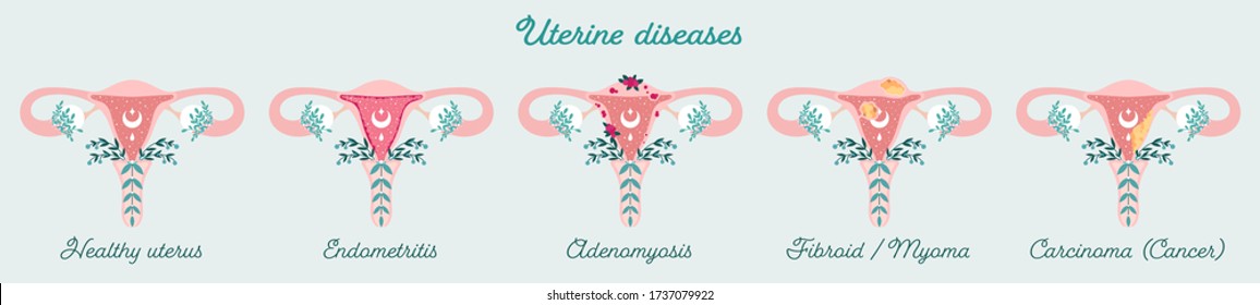 Women health - Uterus in flowers diagram. Anatomical schemes Uterine diseases - like adenomyosis, fibroid, cancer e.t.c. Gynecological diseases of womb - Isolated patient-friendly infographic