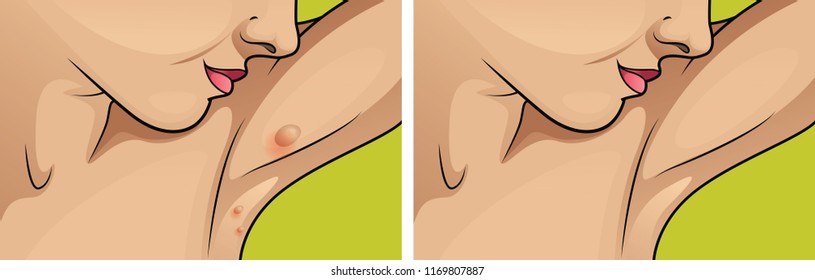 Women with moles on the skin