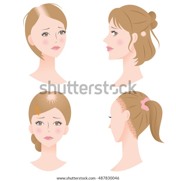 Women Pattern Hair Loss Get Receding Beauty Fashion Healthcare