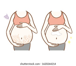 Women with pregnancy line and women applying cream to prevent pregnancy line.
