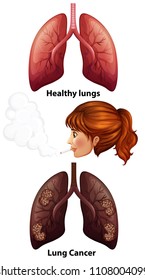 Women smoking with healthy and cancer lungs illustration