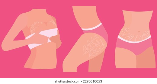 Women with stretch marks on their bodies against pink background