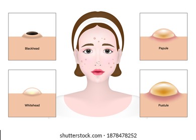 1,972 Papules pustule Images, Stock Photos & Vectors | Shutterstock