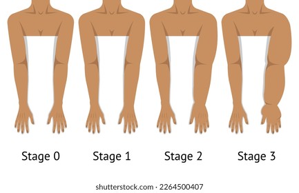 Los brazos de las mujeres en diferentes etapas del linfedema. Ilustración del vector