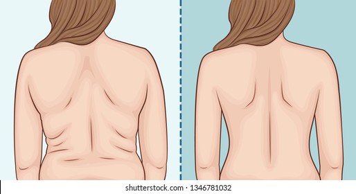 Women's back before and after weight loss.