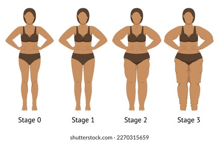 El cuerpo femenino en diferentes etapas de Lipedema. Ilustración del vector