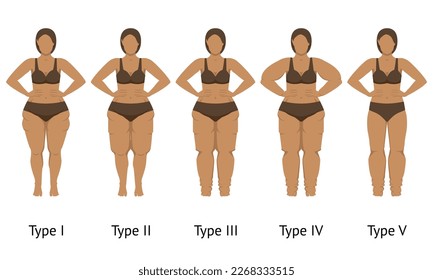 Women's body in different types of Lipedema. Vector illustration