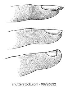 Women's finger with lang, normal and short nail / vintage illustration from Die Frau als hausarztin 1911