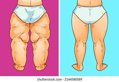 Women's legs with health problems. Healthcare illustration, medical infographics. Before, after. Vector illustration. svg
