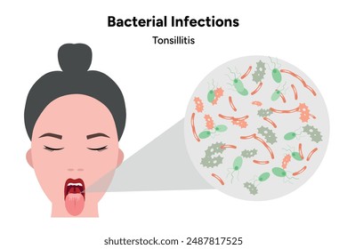 WOoman and Bacterial infections tonsillitis, open mouth with zoom bacterials