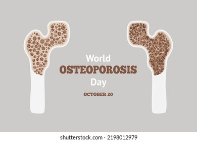 World Osteoporosis Day. Osteoarthritis Of Human Anatomical Bones. Information Poster About Diseases Of Bone System And Osteoporosis To Prevent Loss Of Bone Density. Vector Illustration