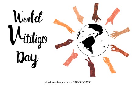 Cartel del Día Mundial del Vitiligo con letras. Diversas etnias en diversos gestos con enfermedad de la piel. Problema de despigmentación. Pérdida irregular del color derma. Solidaridad Humana.