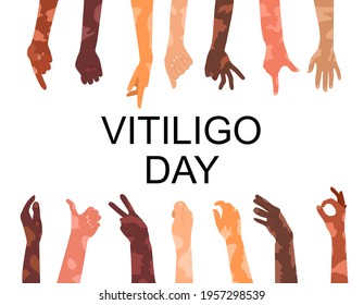 World vitiligo day poster.Hands different ethnicities in various gestures with skin disease. Depigmentation problem. Patchy loss of derma color. White spots. Human Solidarity.