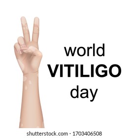 World vitiligo day. Vector illustration for templates and web banners