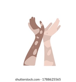 World vitiligo day vector template. Hands with vitiligo isolated on a white background.