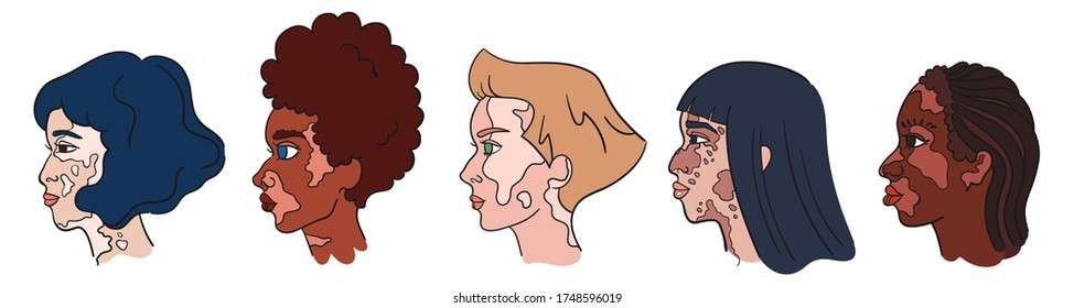 World Vitiligo Day. Women faces with pigment spots. Isolated portraits - vector vitiligo set. Collection of profile portraits about diversity. Beautiful girls of different races
