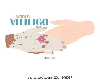 World Vitiligo Day.June 25.Two hands joining hands on a white background, one of them with vitiligo and one without to avoid the stigmatization of this disease.
