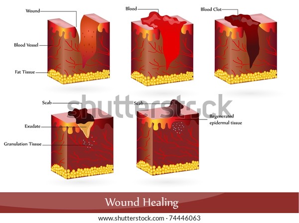 Wound Healing Illustration Showing Skin After Stock Vector (Royalty ...