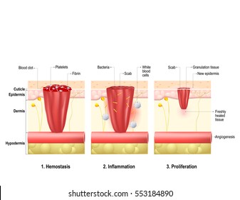 Wound Healing. Process In Body Tissue Repairs After Trauma. Phases Wound Healing: Hemostasis, Inflammation And Proliferation