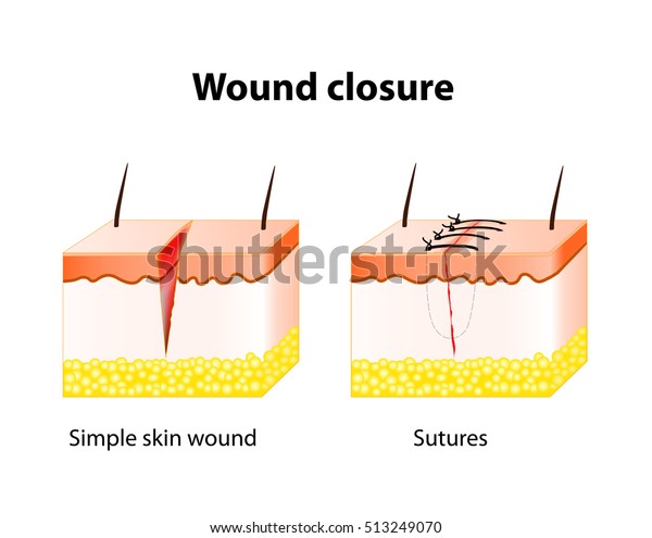外科縫合による創傷治癒過程 外科的な傷の端の位置を確保するために作られた一連の縫い目 のベクター画像素材 ロイヤリティフリー