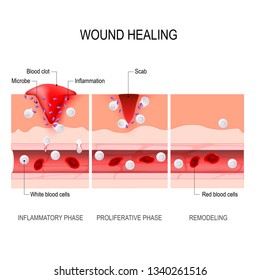 Wound Healing Process. Hemostasis, Inflammatory, Proliferative, Maturation And Remodeling. Tissue Injury And Inflammation. Immune System. Vector Diagram For Medical, Educational And Scientific Use.