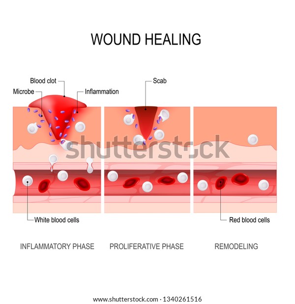 Wound Healing Process Hemostasis Inflammatory Proliferative Stock Vector Royalty Free 1340261516