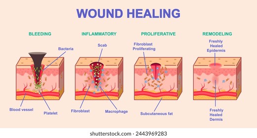 Wound healing process. Medical infographics or diagram with stages or phases of skin regeneration after injury. Bleeding, Inflammation, Proliferation and Remodeling. Cartoon flat vector illustration