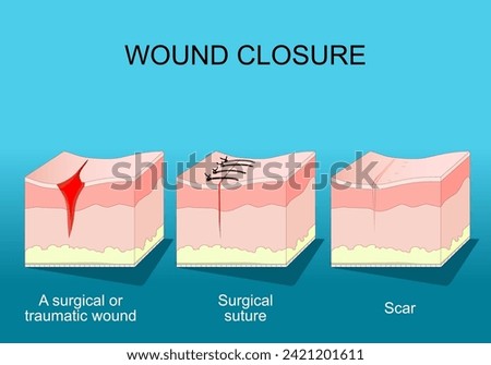 Wound healing. Skin before and after Wound Closure. From surgical or traumatic wound to suture and scar. A fibrous tissue replaces normal skin after an injury healing process.