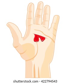 Wound on hand