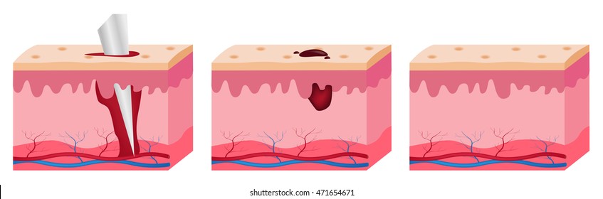 Wound Skin Vector Graphic . 3 Stages Of How To Heal Wound