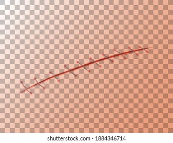 Sutura de heridas en una ilustración de fondo transparente